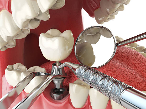 Best Root Canal Emergency Dentist  in Santa Fe, TX